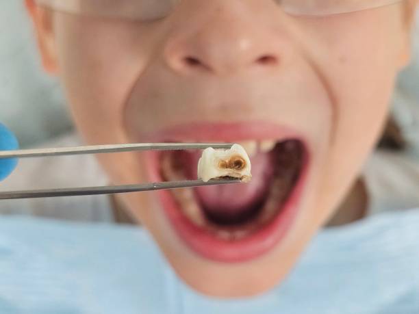 Best Emergency Wisdom Teeth Removal in John Day, OR